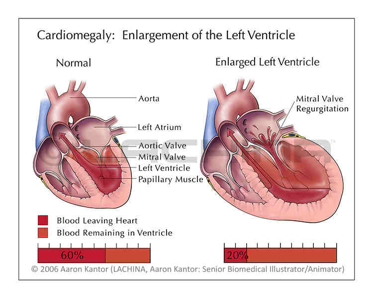 cardiomegaly-medical-terminology-blog