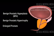 Video - Benign Prostatic Hypertrophy BPH