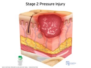 pressure-injury-pressure ulcer