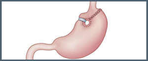 medical suffixes-gastroplasty