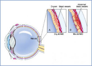 Macular Degeneration