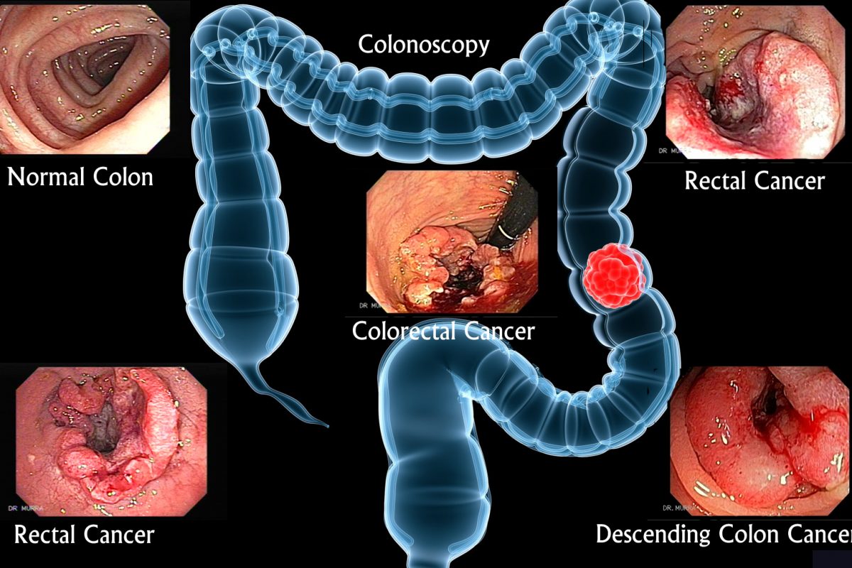 colorectal cancer screening - colonoscopy