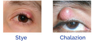 Stye or Chalazion - Eye Disorder