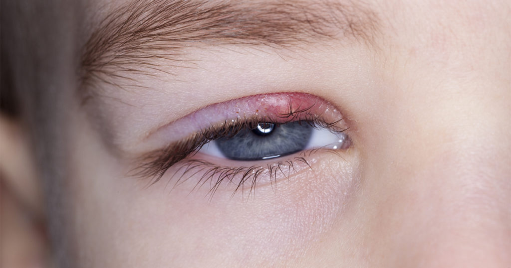 Stye | Chalazion | Sty Chalazion, Stye, And Sty - What's The Difference ...