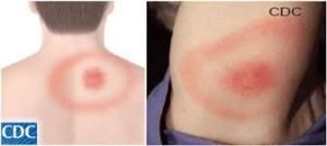 Erythema migrans - a rash associated with a deer tick bite