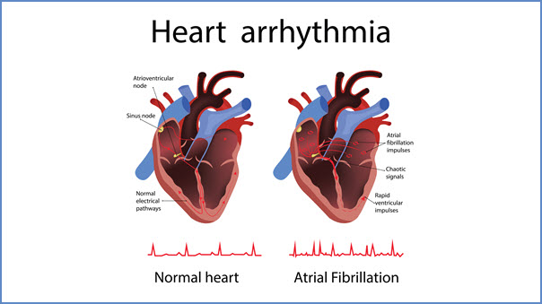 Arrhythmia Dysrhythmia | Medical Terminology