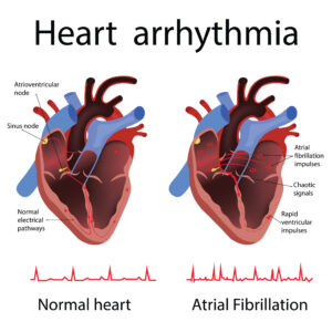 Medical Terminology - Arrhythmia versus Dysrhythmia