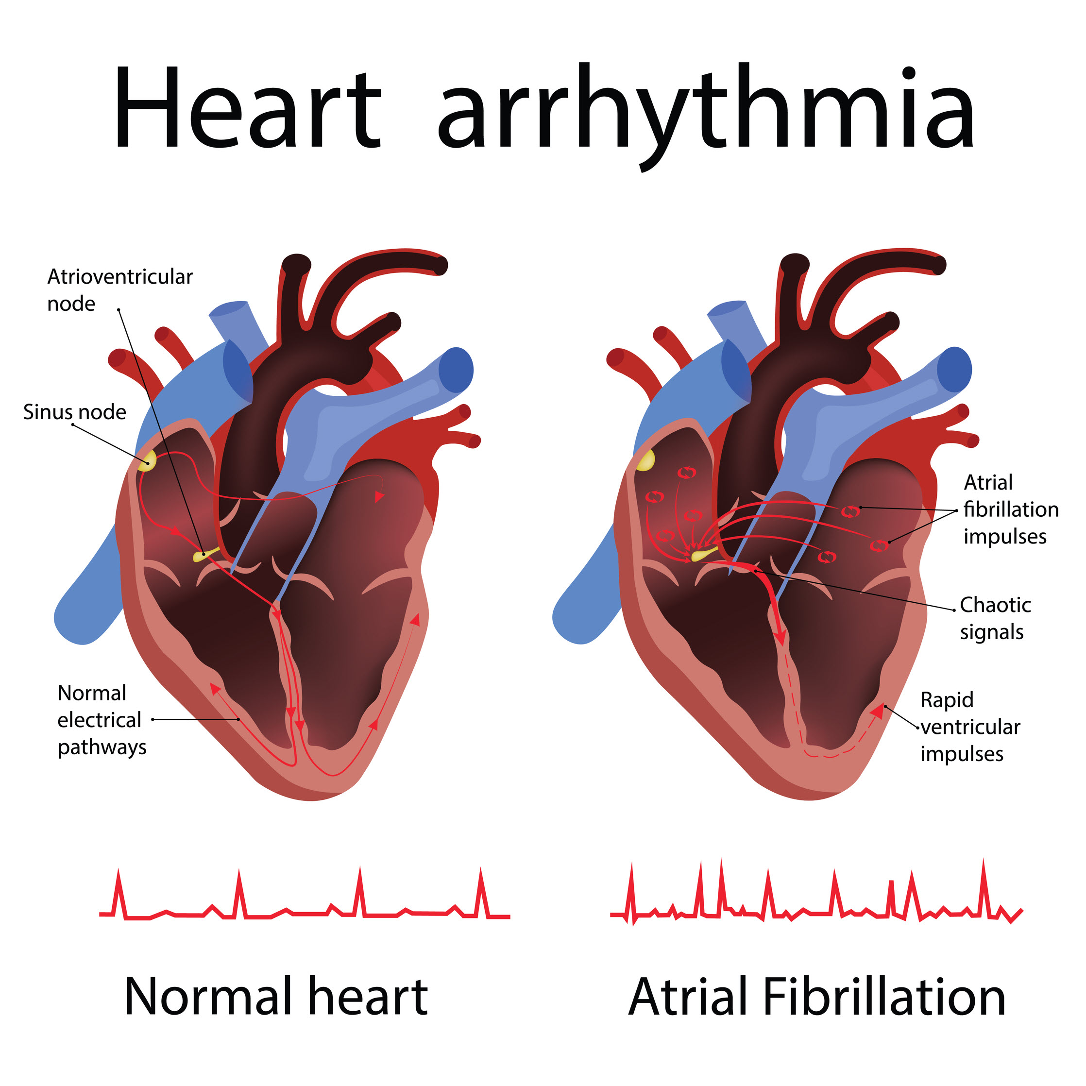 10 Symptoms of arrhythmia You Should Never Ignore