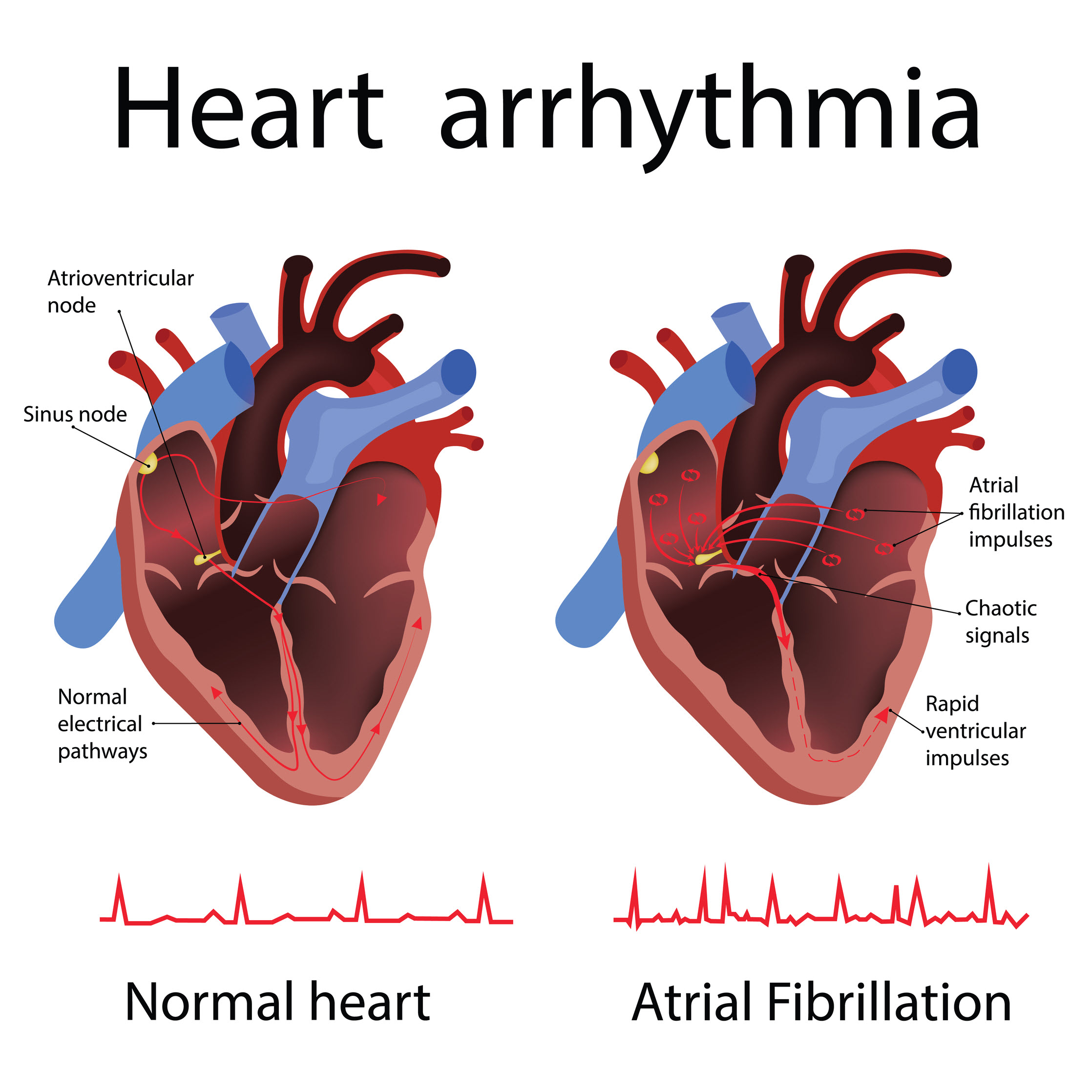 medical-terminology-arrhythmia-versus-dysrhythmia-lg-medical