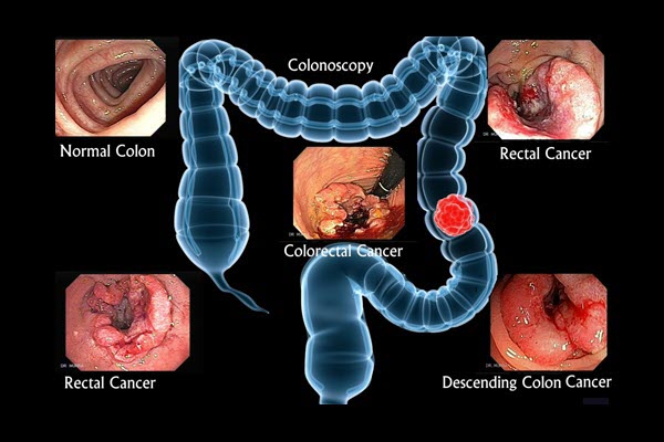 Colon Cancer