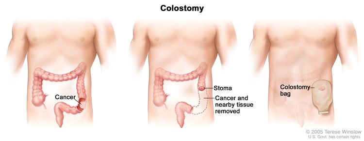 Colon Cancer Colostomey