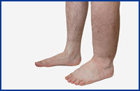 Edema - Medical Terminology
