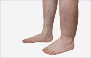 Types of Edema