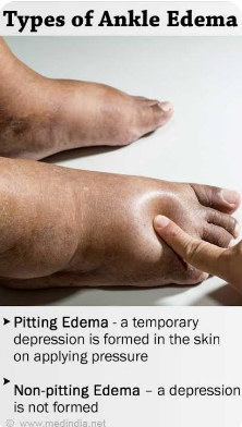 Types of Edema